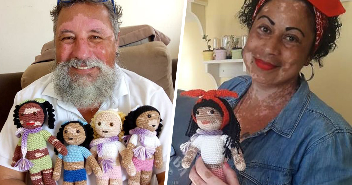 Ce grand-père est atteint de vitiligo et crochète des poupées pour ...