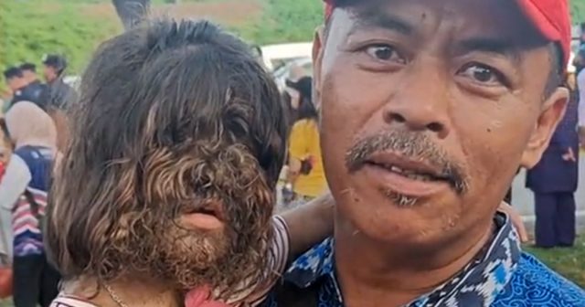 En Malaisie, une fillette de deux ans atteinte d'une maladie rare connue sous le nom d’hypertrichose, ou « syndrome du loup-garou », a retenu l'attention de la famille royale.