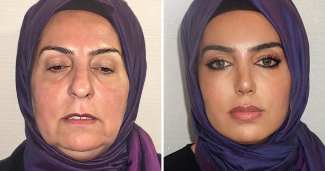 Une chirurgienne esthétique turc a montré la transformation d'une femme de 68 ans sur une période de deux ans, grâce à de multiples interventions chirurgicales.