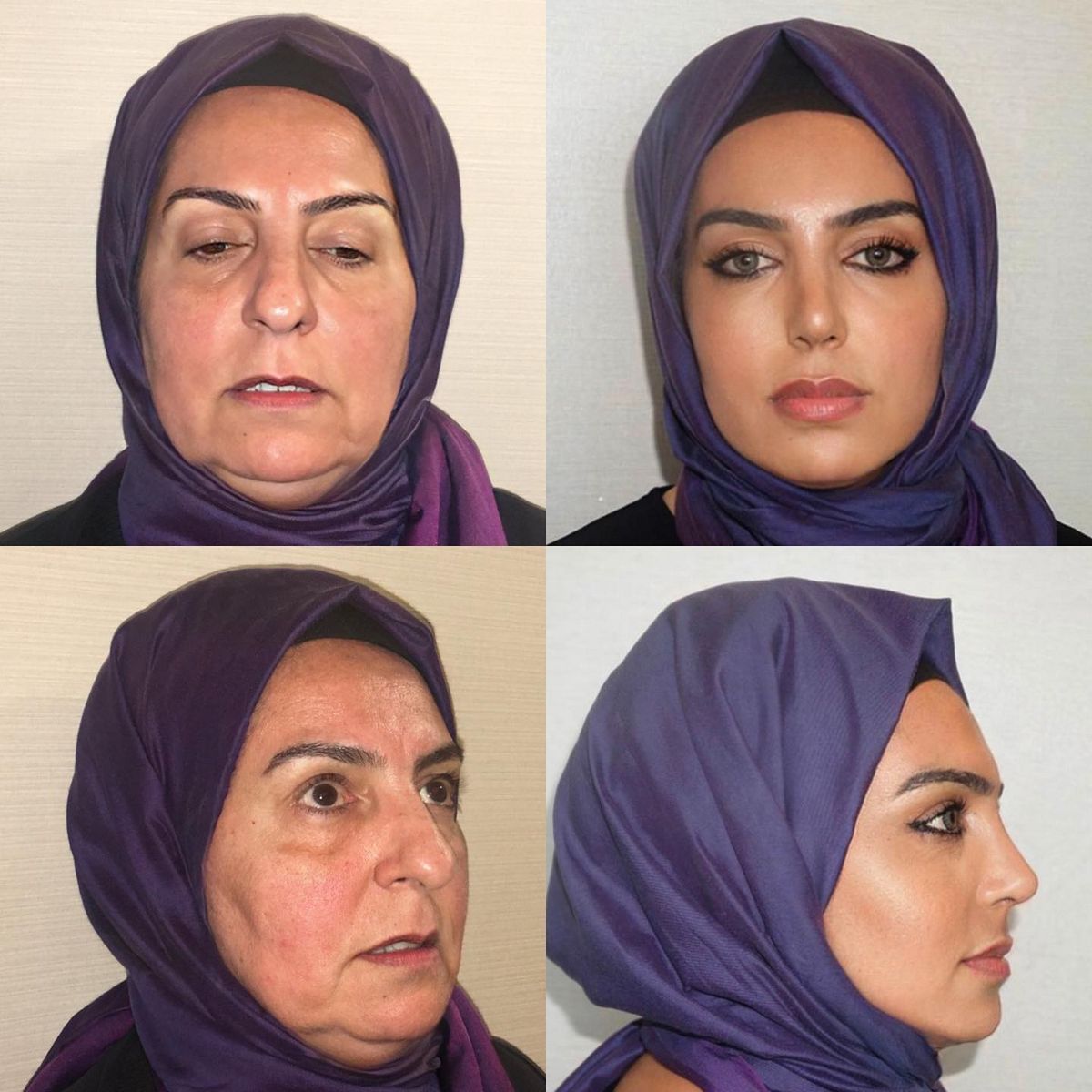 Le chirurgien a partagé ces photos sur Instagram, attribuant la transformation à des opérations de rhinoplastie, de lifting du visage et de blépharoplastie.